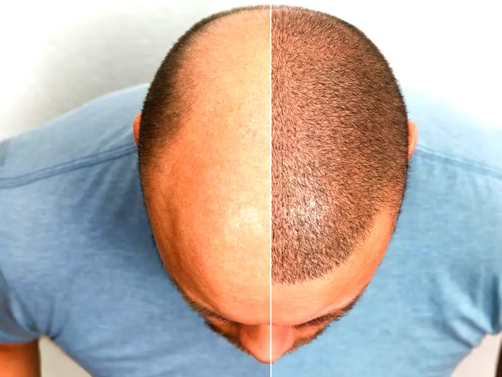 Side Effects of Hair Transplant That You Must Aware Of