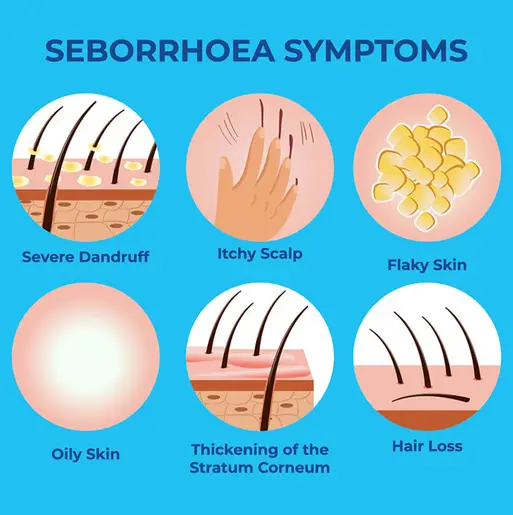 seborrhoea symptoms