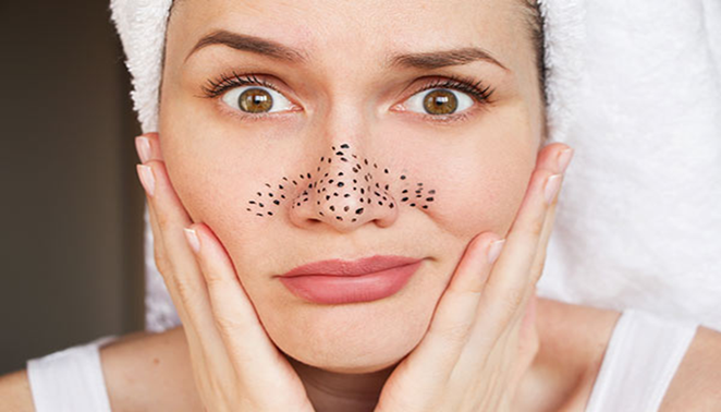 blackheads