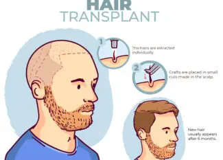 hair transplant in india
