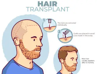 hair transplant in india