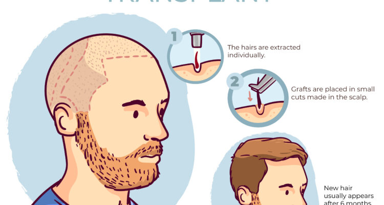 hair transplant in india