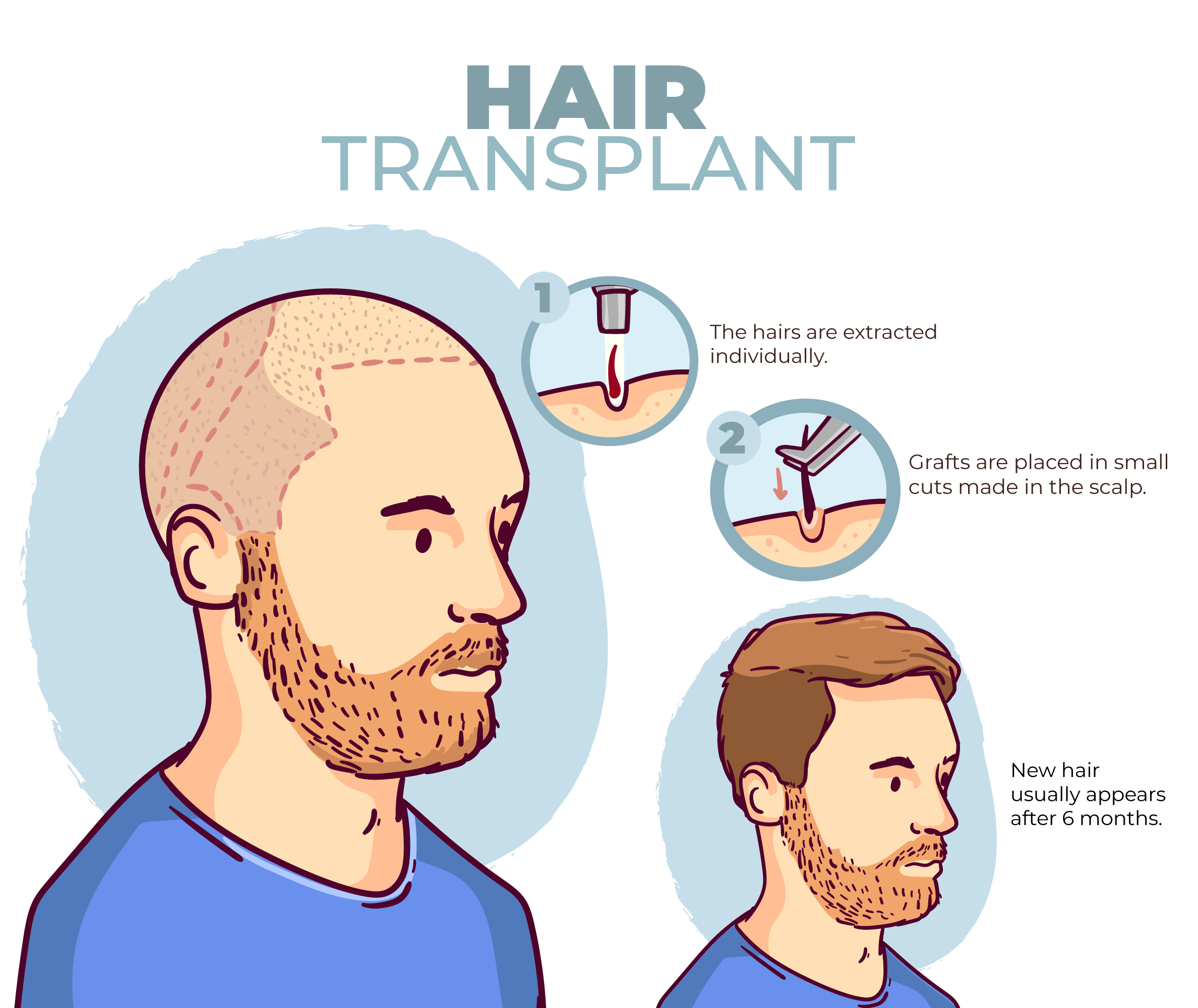 hair transplant in india