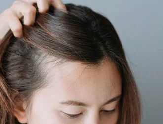 postpartum hair loss