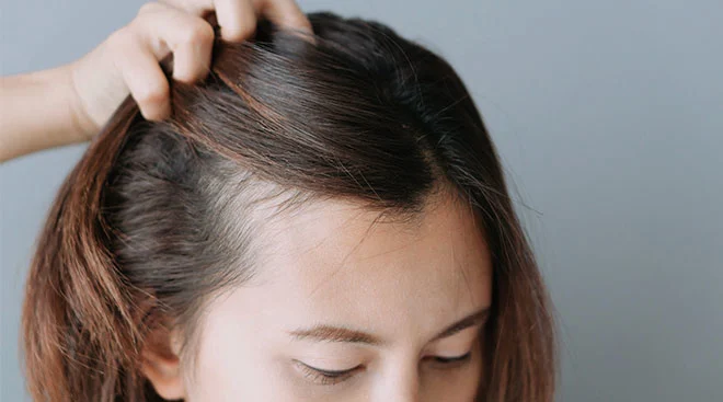 postpartum hair loss